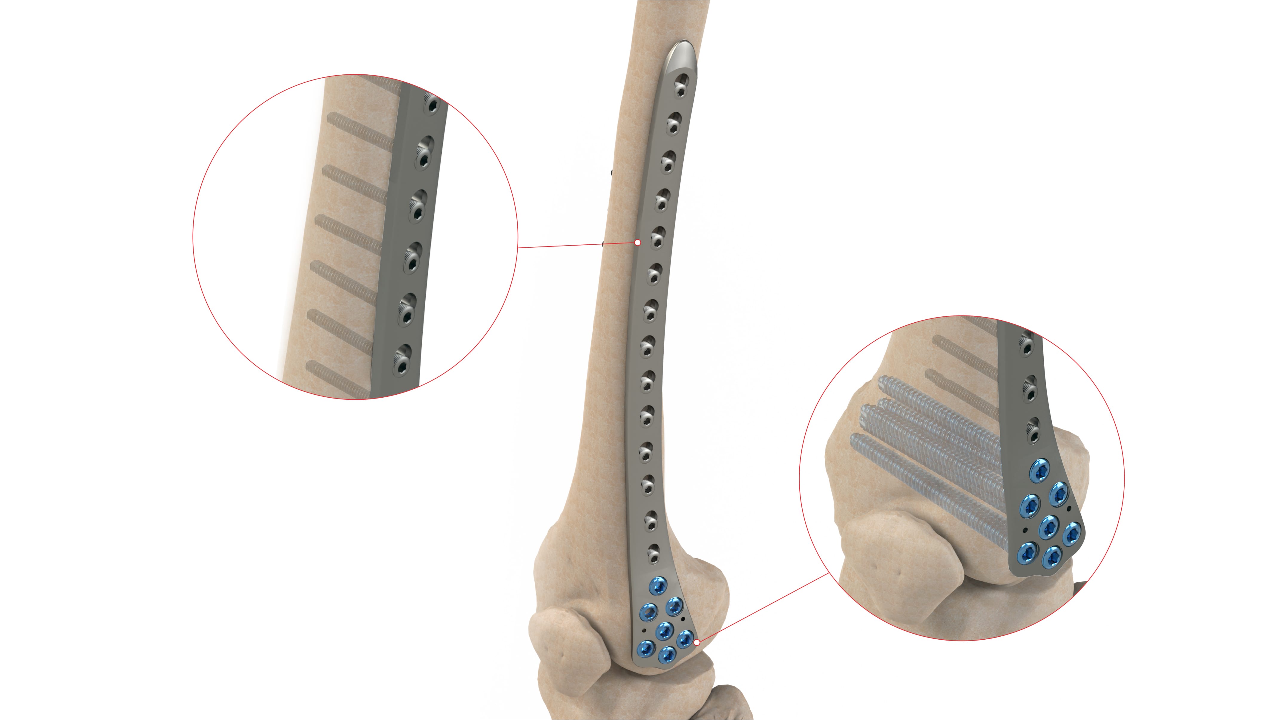 DISTAL RADIUS VOLAR PLATE                    -DISTAL FEMORAL CONDYLE PLATE