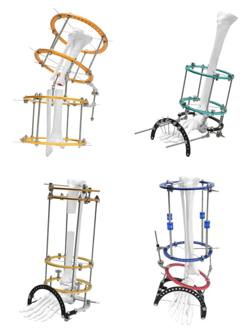 Ortopedik dış fiksasyon