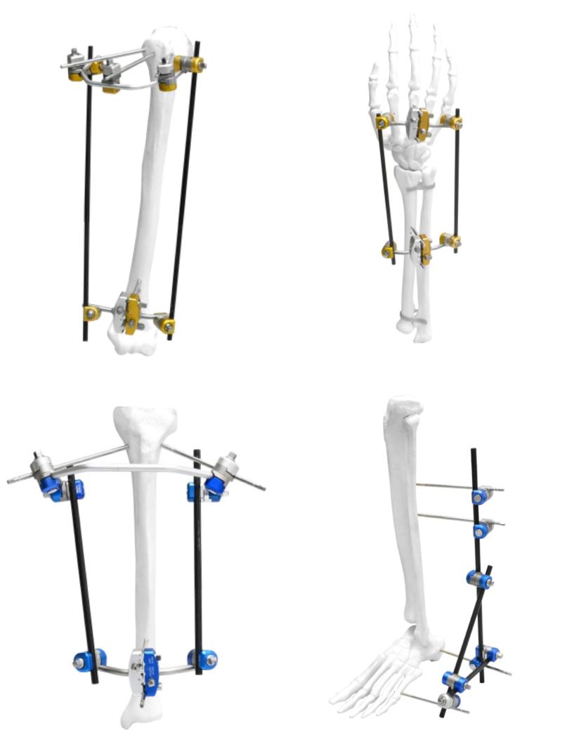 Ortopedik dış fiksasyon