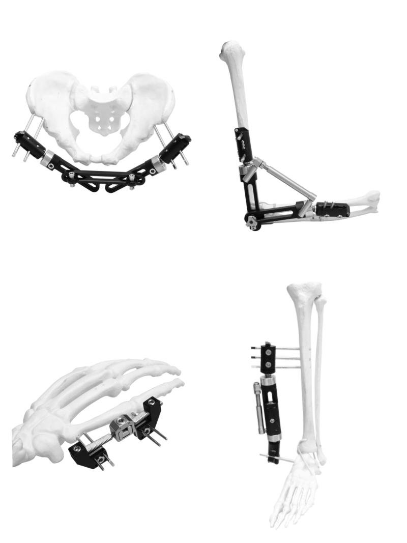 Ortopedik dış fiksasyon