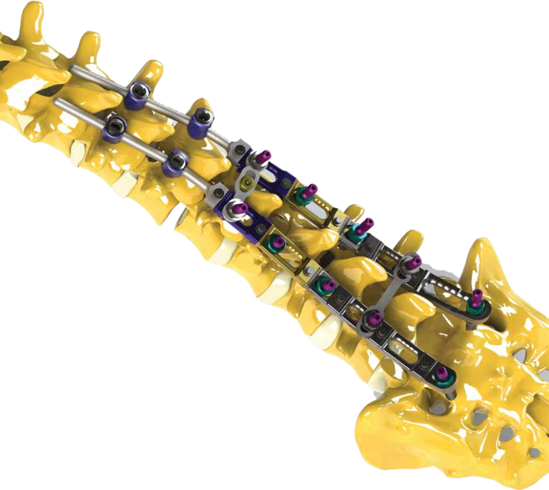 lomber enstrümantasyon