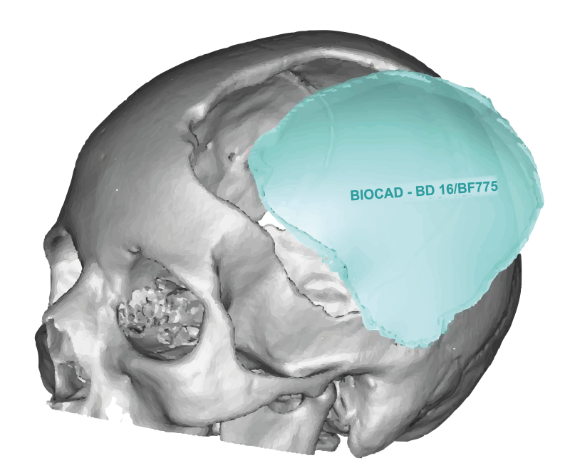 Custom Made Prosthesis in PMMA